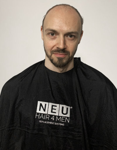 NEU-HAIR-4-MEN-BEFORE-IMAGE-5-400x516